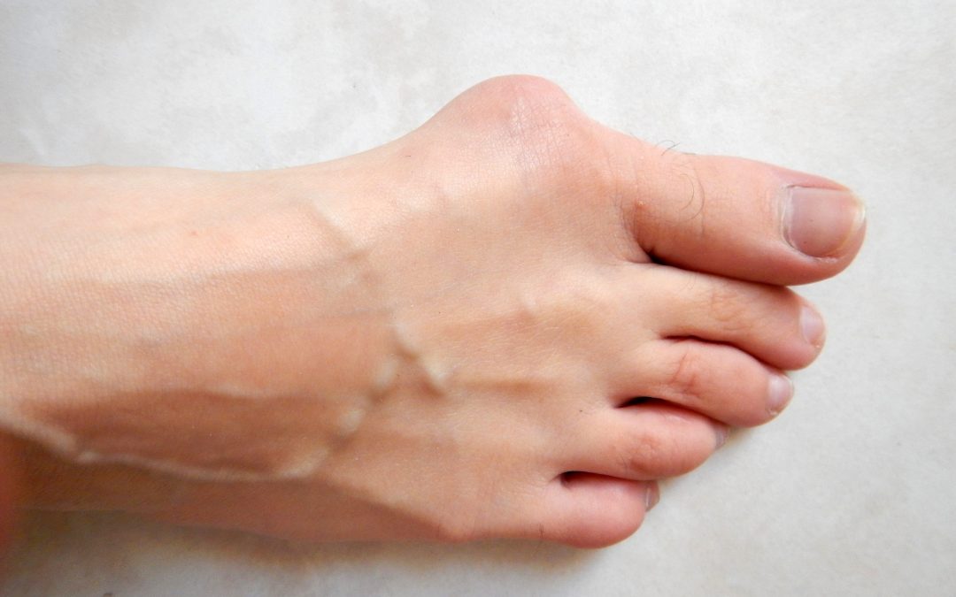 OMG! I Have A Bunion!