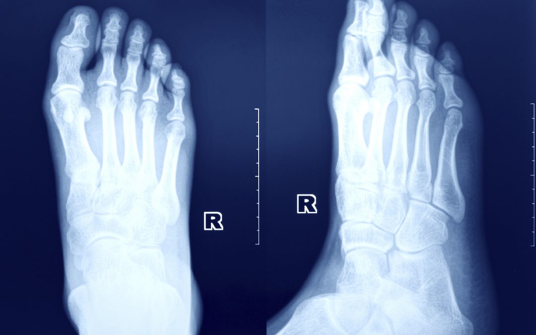 Heel Pain Sufferers Must Read This!