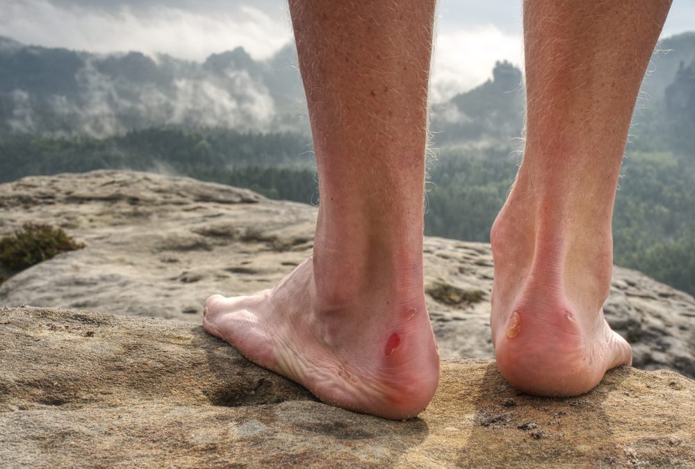 BLISTERS!