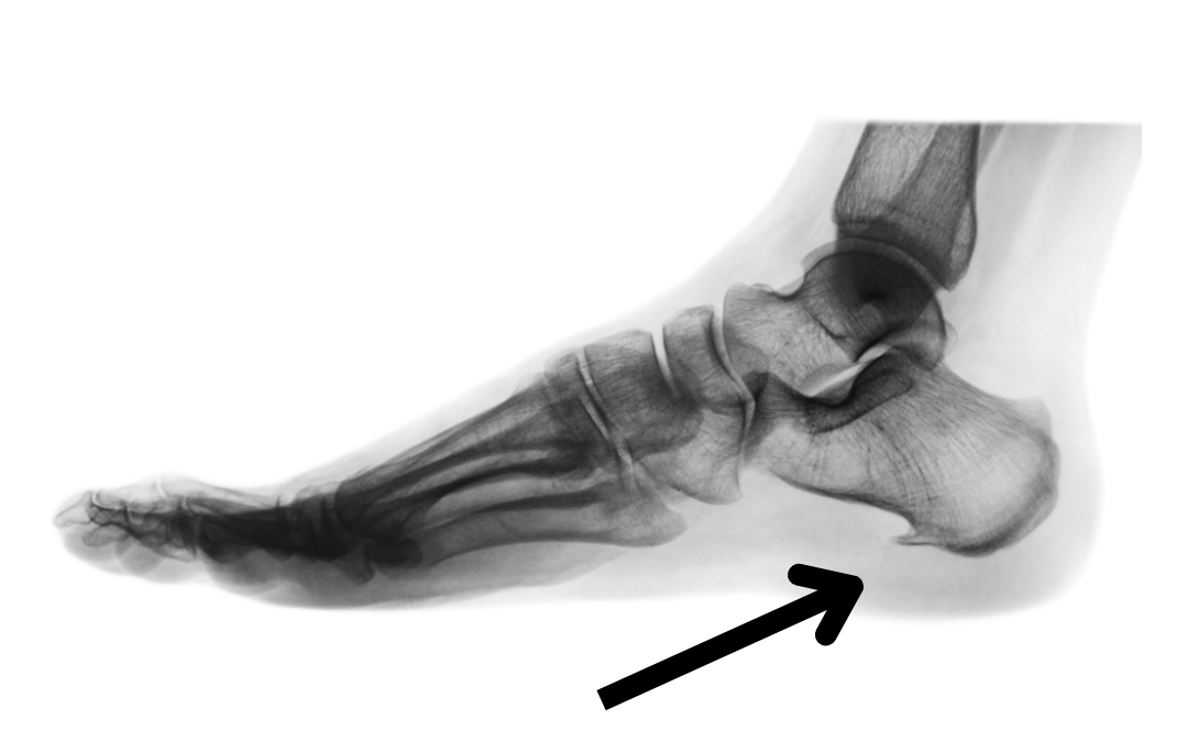MYTH – My Heel Spur is causing my pain.