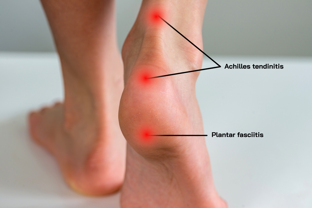 Shockwave Therapy – Achilles Tendon and Heel Pain